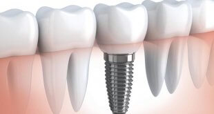Implant Dentar Brasov